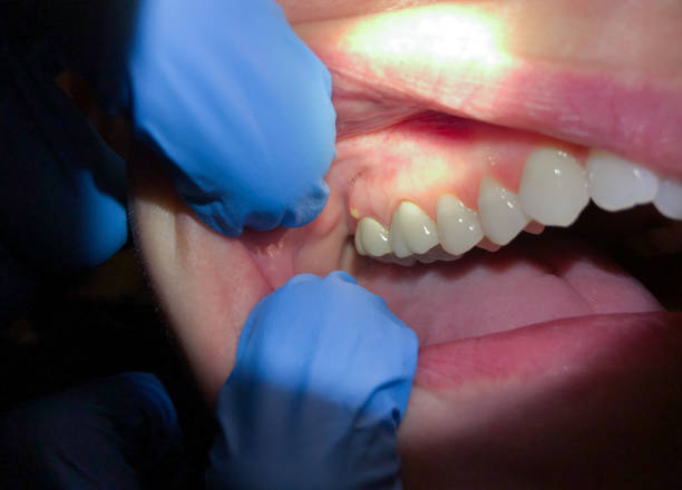 Best Emergency Wisdom Teeth Removal in , NV